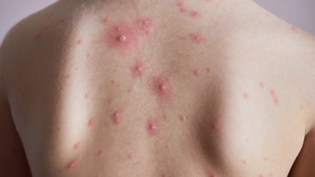 Casos de varicela en 2025 duplican los registros del año pasado en&nbsp;Tabasco