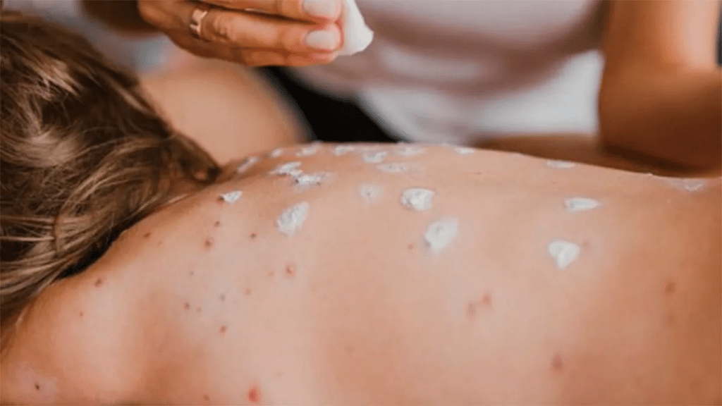 México acumula 12 muertes por&nbsp;sarampión