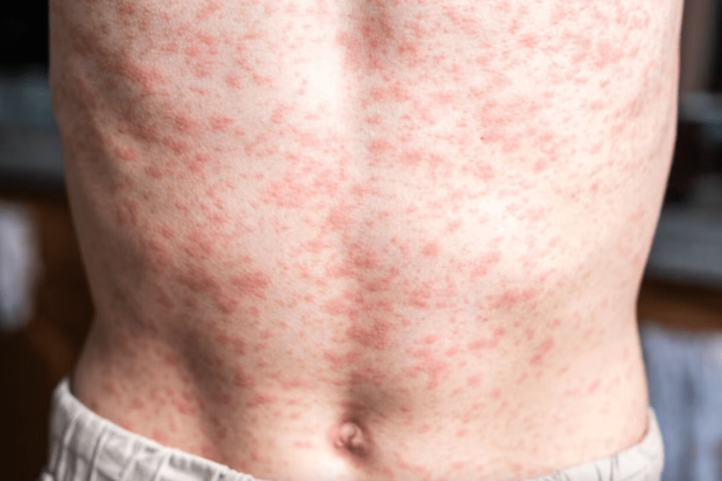 Muere niño por complicaciones de sarampión en&nbsp;Tlaxcala