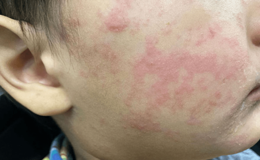 Sarampión supera los 2 mil casos en lo que va de&nbsp;2026