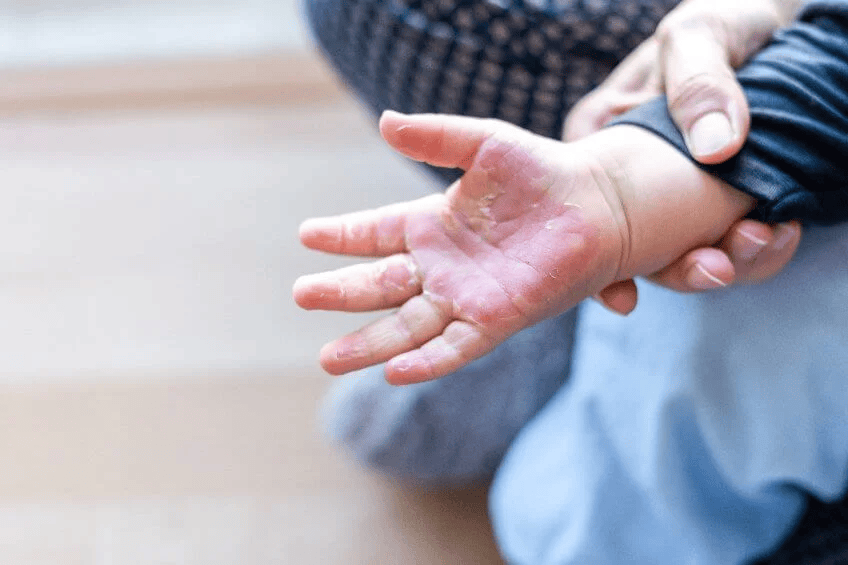 Quemaduras por líquidos calientes, entre las principales atenciones a niños en&nbsp;Tabasco